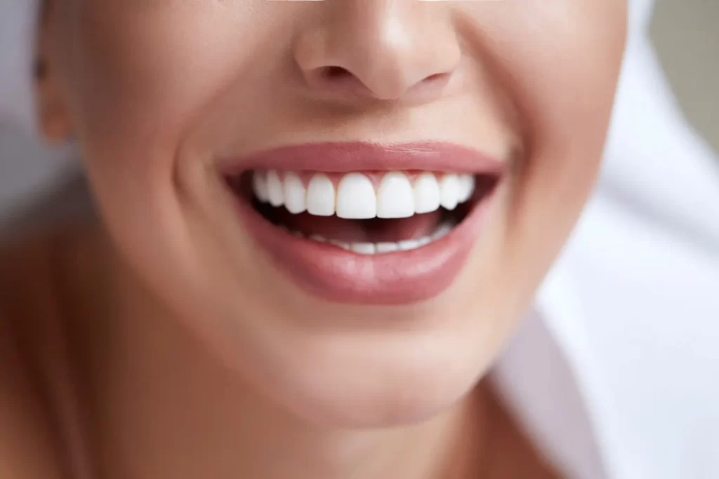 Porcelain vs. Composite Veneers